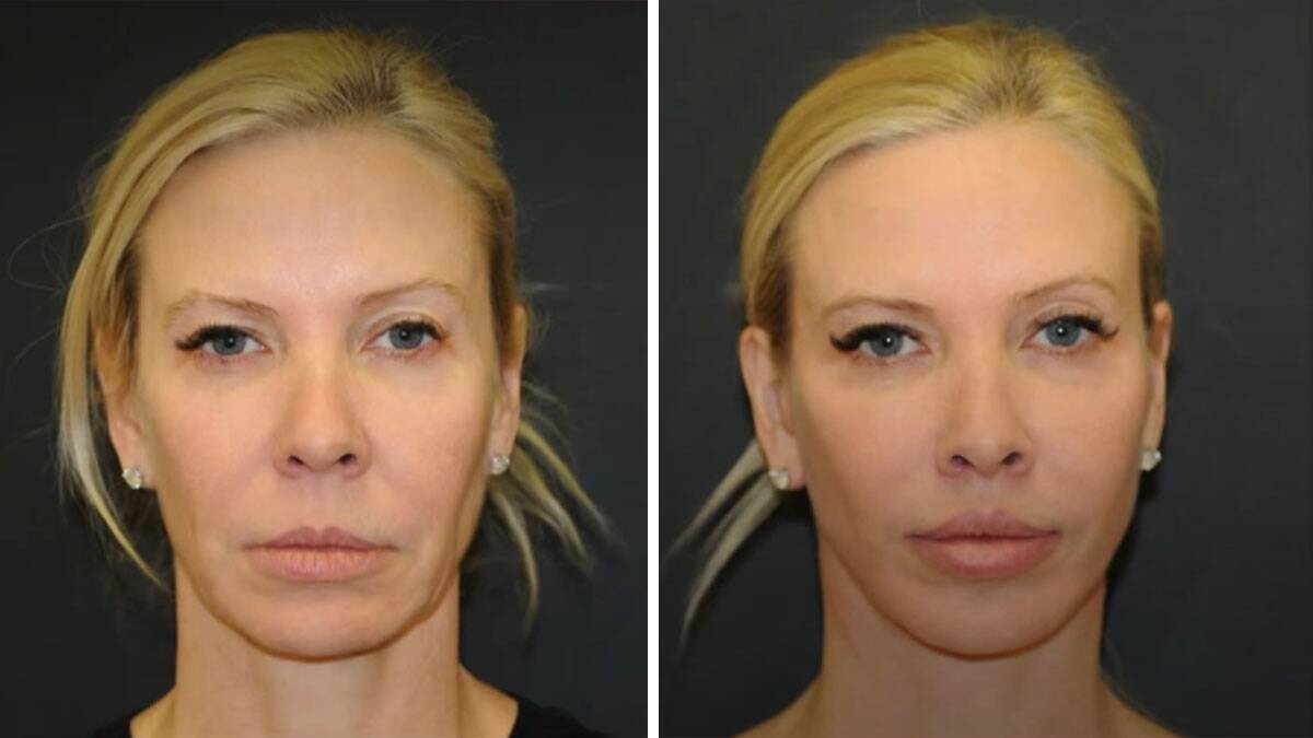 "Pustila sam muža da mi operiše lice: Ovo je najteže, spavanje u krevetu je gore nego da legnete pod skalpel"