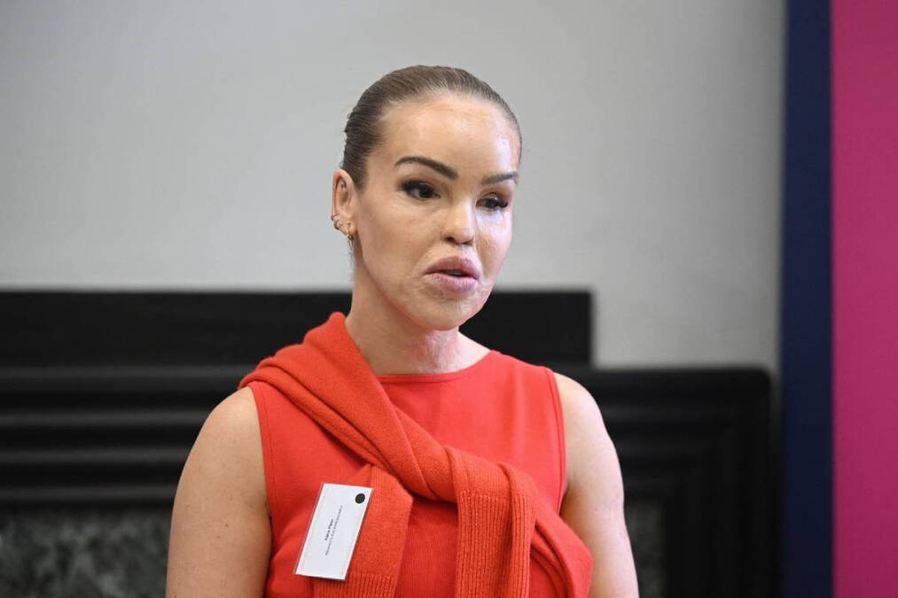 Tražili od AI da izgleda "normalno" i da joj "popravi lice": Oglasila se voditeljka koju je bivši polio kiselinom