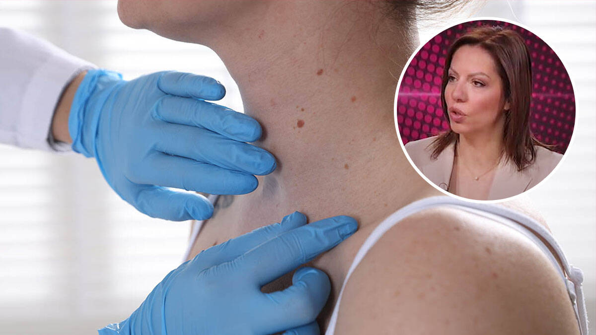 U Srbiji otkrivena 22 melanoma i 253 sumnjive promene: Lekari apeluju da pregledate kožu, ne treba vam uput