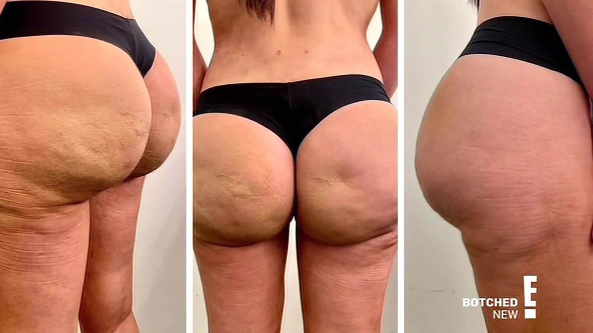 Devojka potrošila milion dolara na operacije 