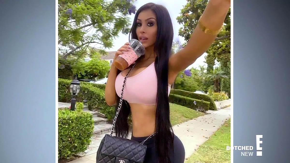 Devojka potrošila milion dolara na operacije 