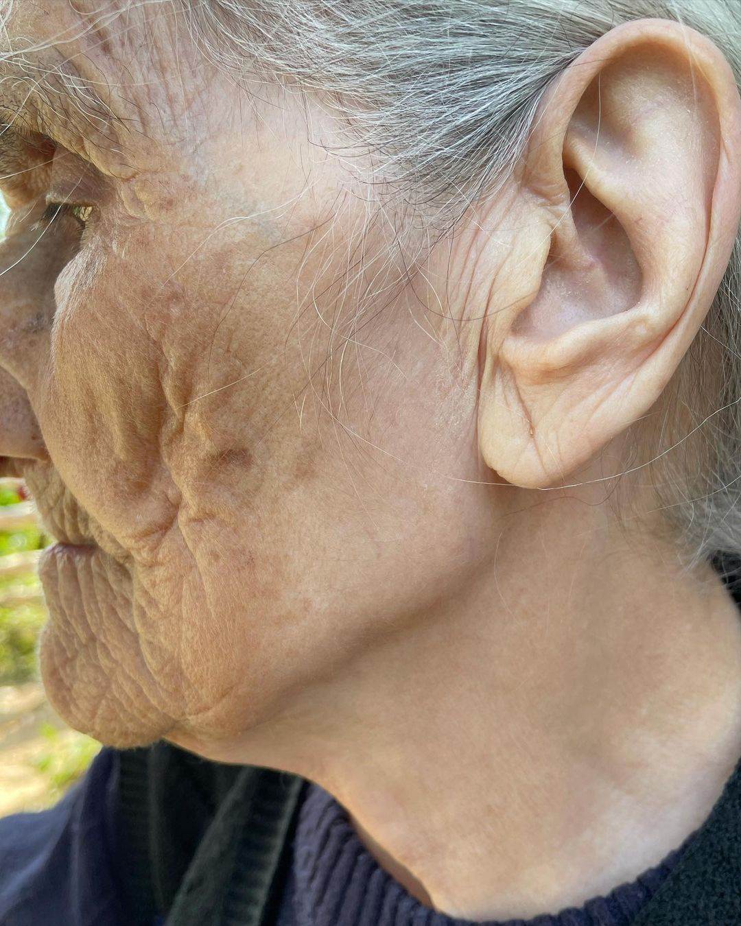 kako izgleda koza izlozena suncu