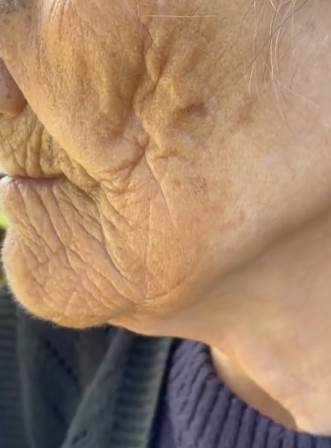 kako izgleda koza izlozena suncu