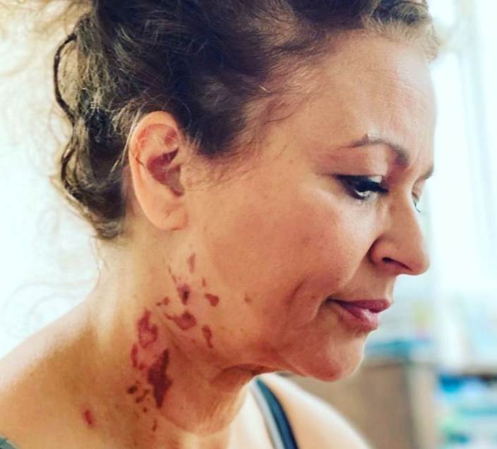 voditeljka opekotine med