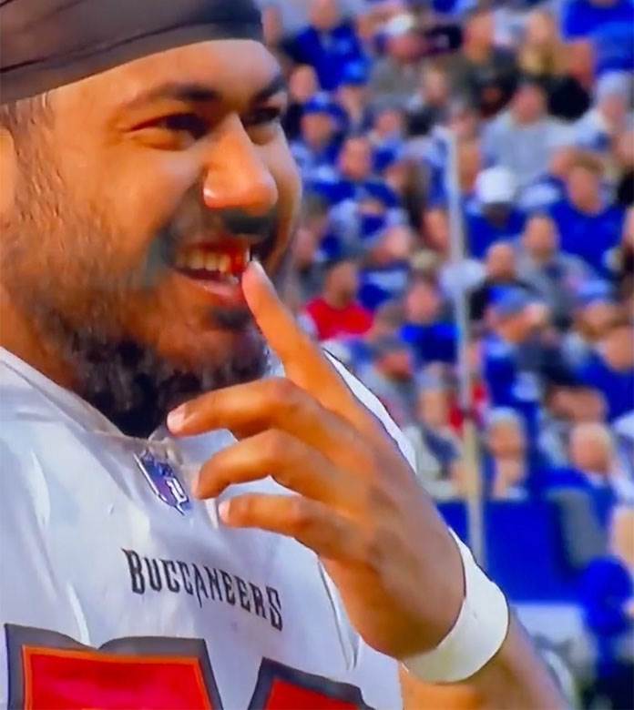 NFL igrač ostao bez zuba u duelu