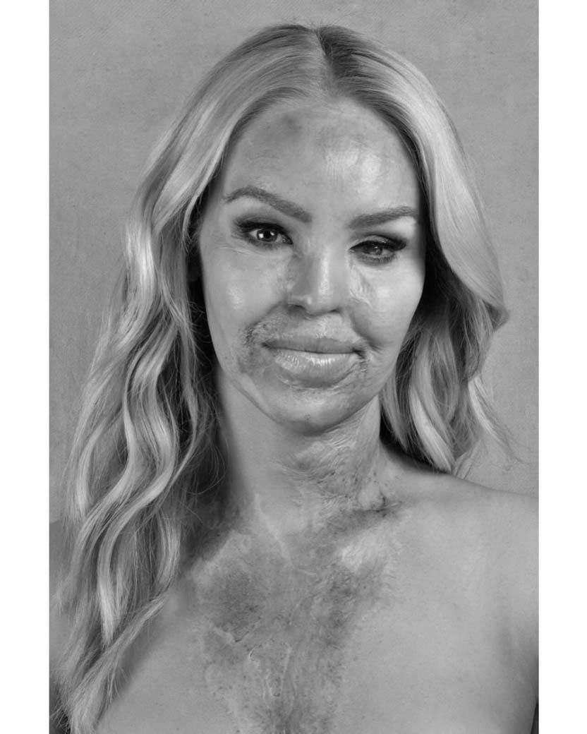 Žena žrtva napda kiselinom silovanje (6).jpg