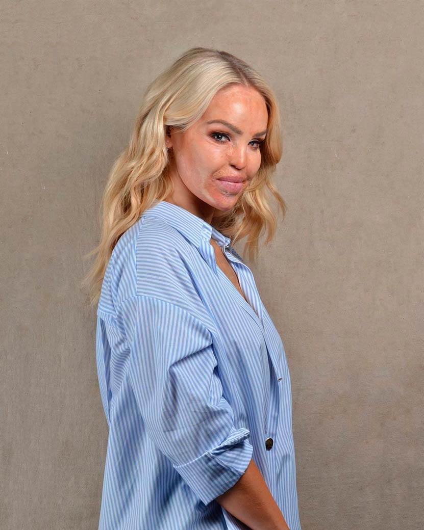 Žena žrtva napda kiselinom silovanje (8).jpg