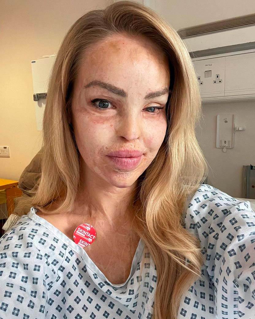 Žena žrtva napda kiselinom silovanje (10).jpg