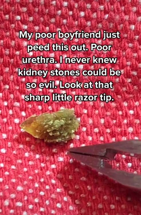 kamen u bubregu 5.png