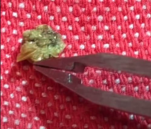 kamen u bubregu 3.png