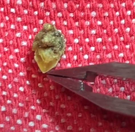 kamen u bubregu 2.png