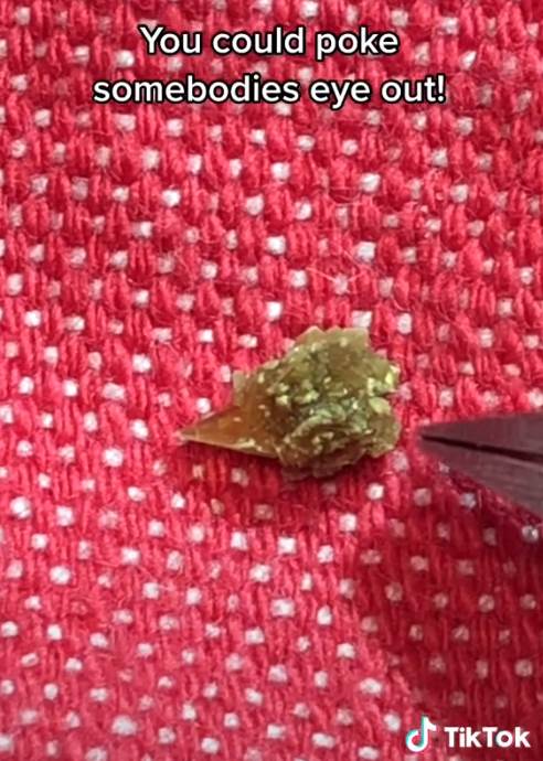 kamen u bubregu 1.png