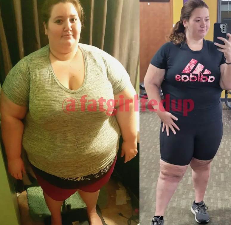 smrsala 136 kilograma i pala u komu1.png