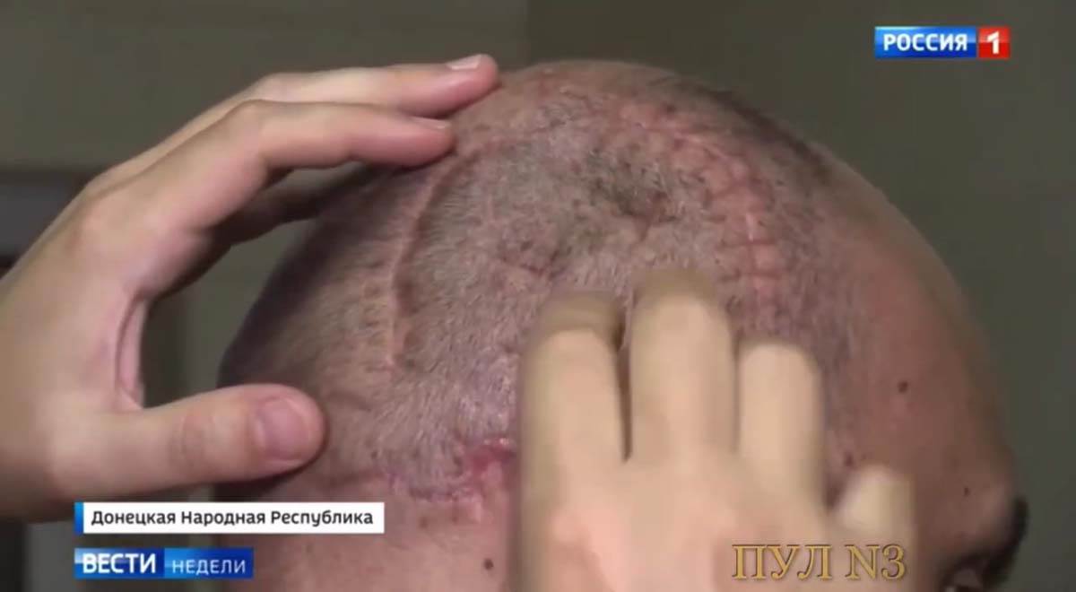 Ukrajina rat upoznao ko ga je ranio  (2).jpg