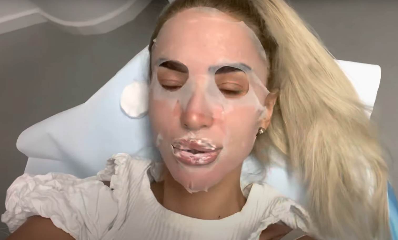 aleksandra nikolic vadila silikon iz usana (5).png