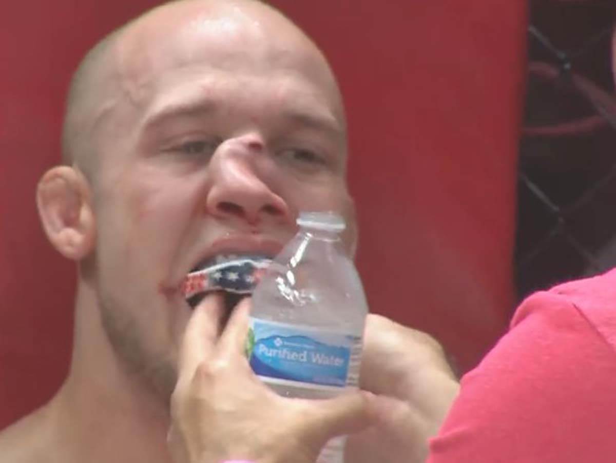 UFC povreda nosa  (4).jpg