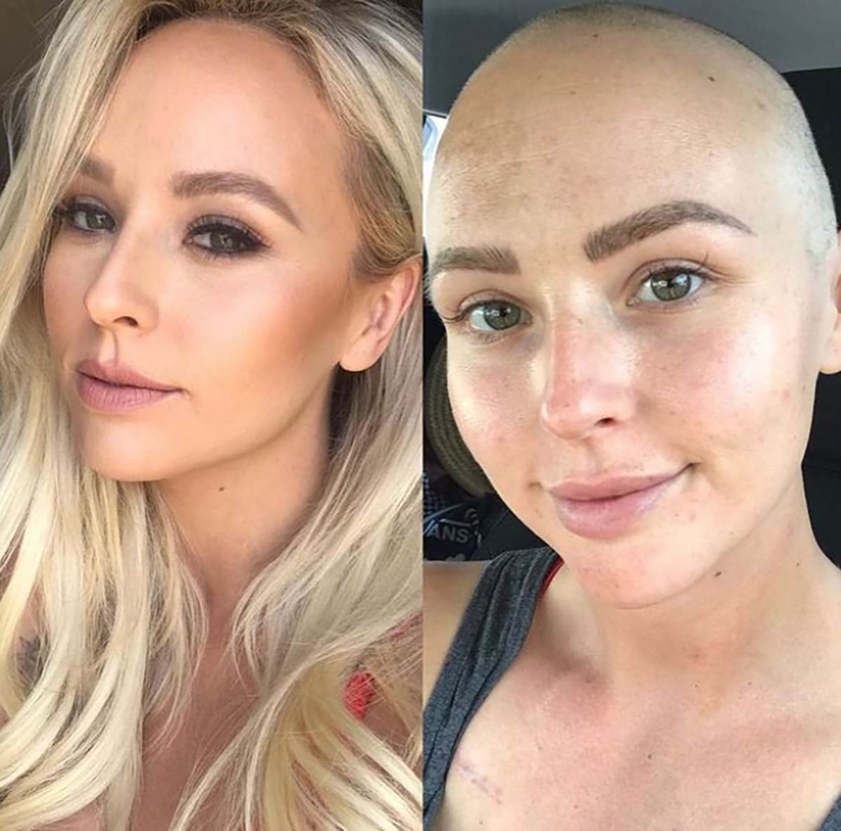 Manekenka o raku dojke