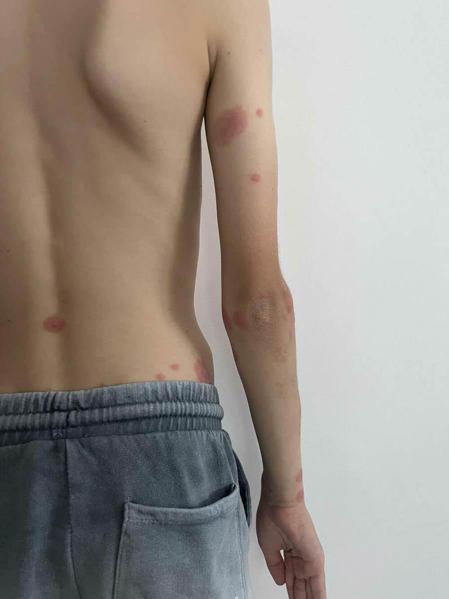 Ujedi stenica (4).jpg