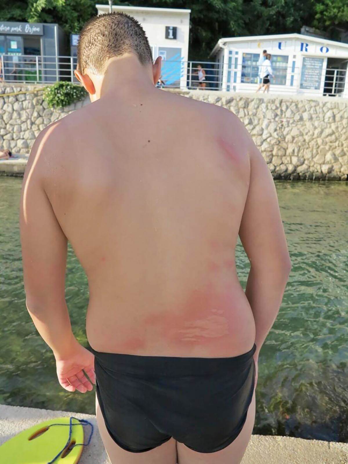 Dečak u Herceg Novom dobio opekotine od meduze