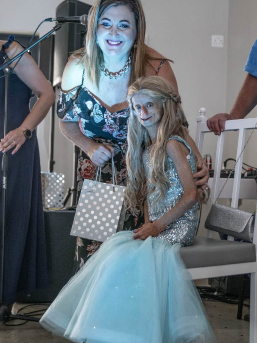 Preminula tiktokerka koja je bolovala od retkog genetskog poremećaja