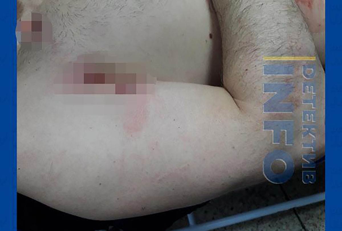 fotografije Radoja Zvicera nakon pokušaja atentata