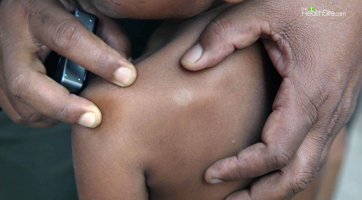 pregled ledja na simptom lepre