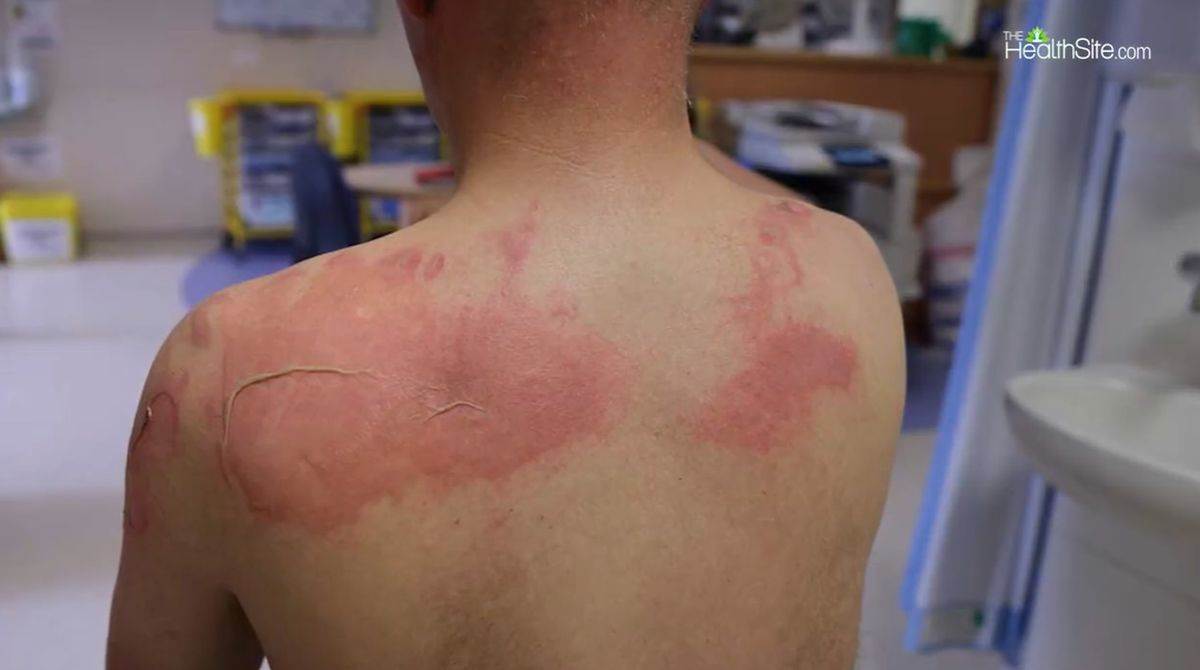 Koža na leđima se ljušti, simptom lepre