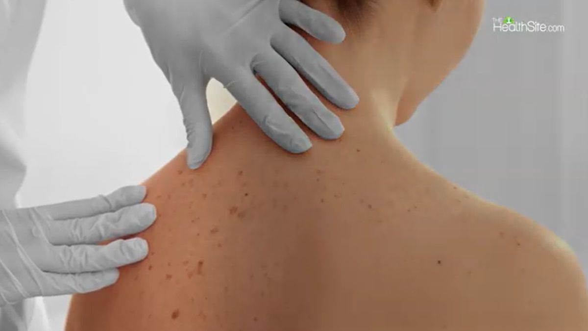 Pregled leđa na simptome lepre