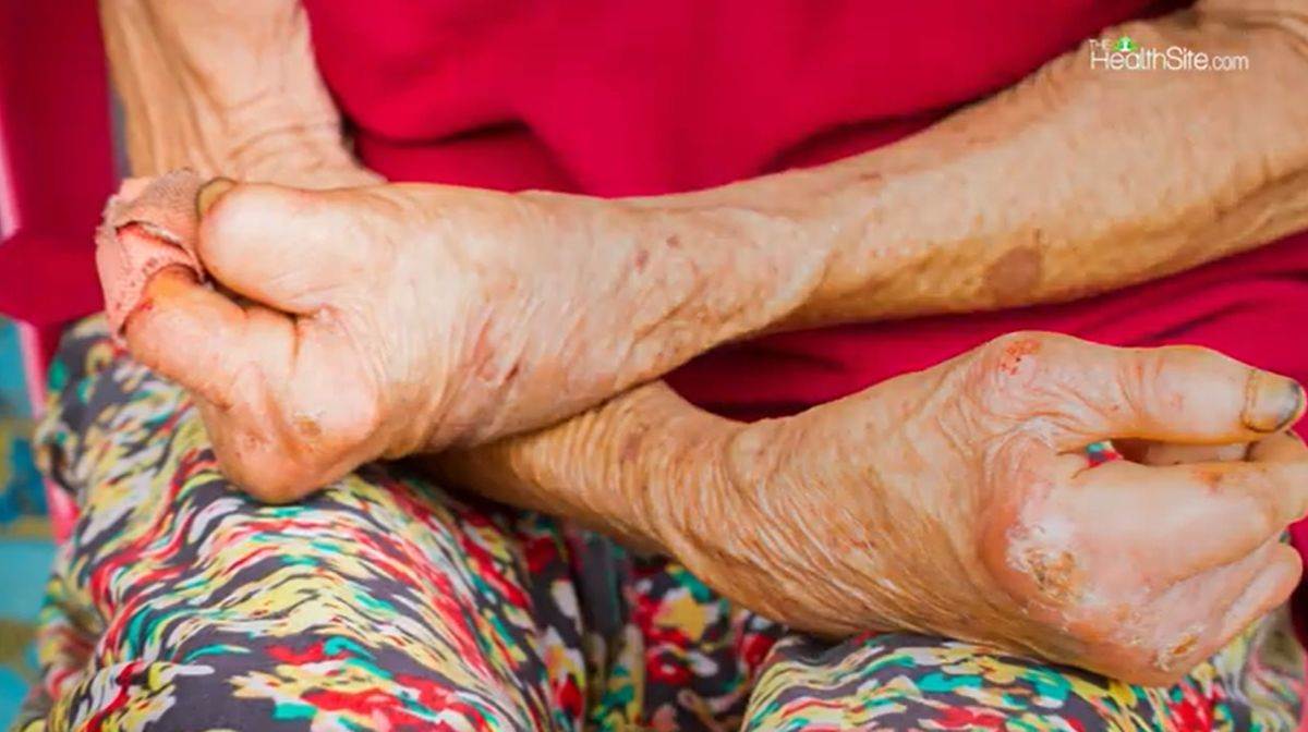 Simptom lepre na rukama i kratki, iskrivljeni prsti