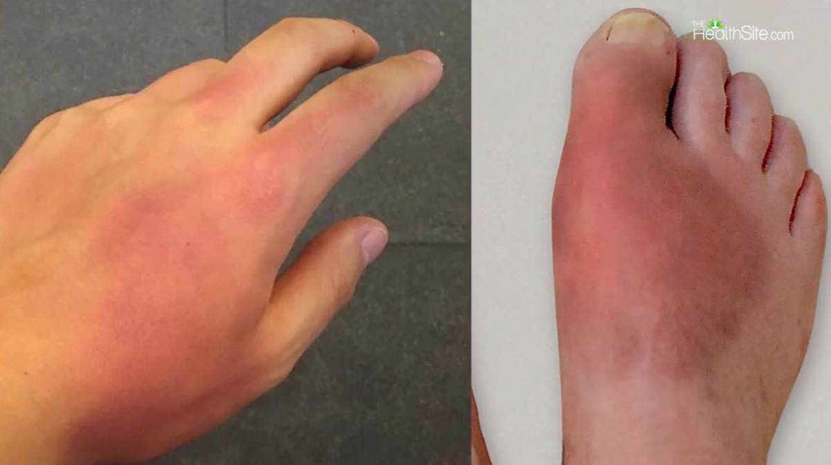 Simptomi lepre na šaci i stopalu