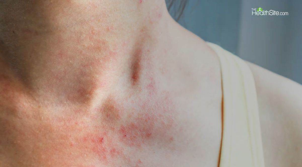 Simptomi lepre kao osip na vratu