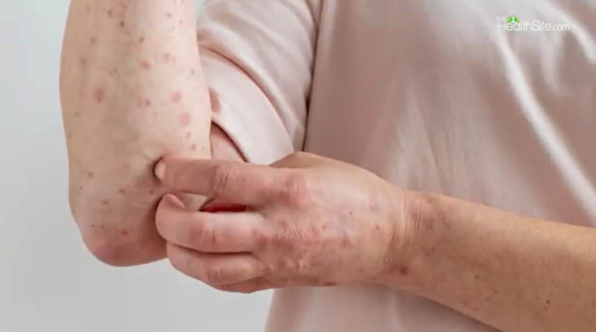 Simptomi lepre na šakama i rukama