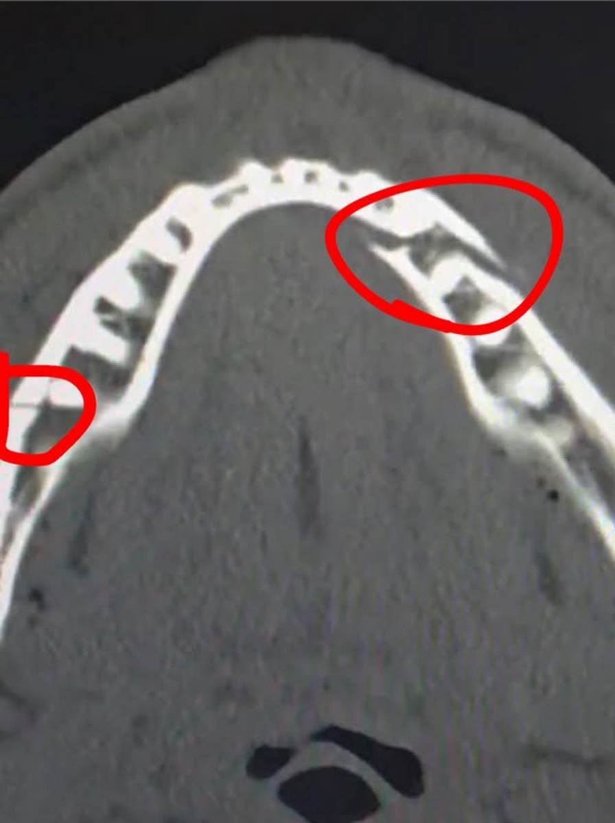 Slomljena vilica Džejk Pola