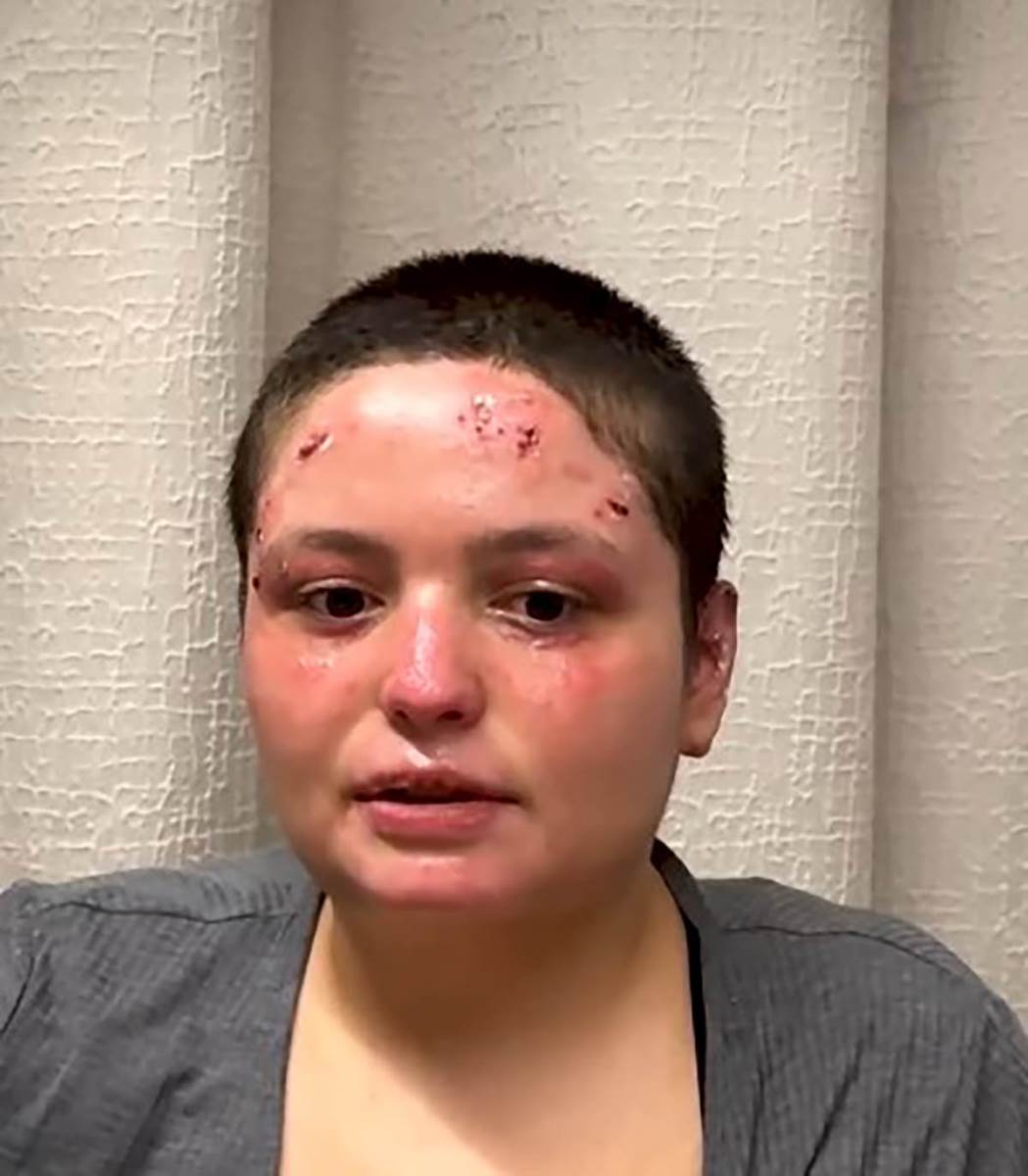 Preživela žrtva požara u Švajcarskoj (2).jpg