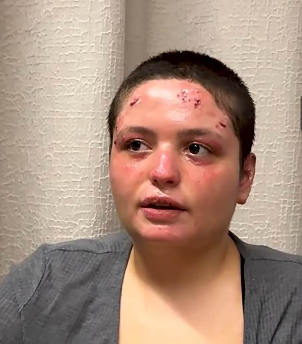 Preživela žrtva požara u Švajcarskoj (3).jpg