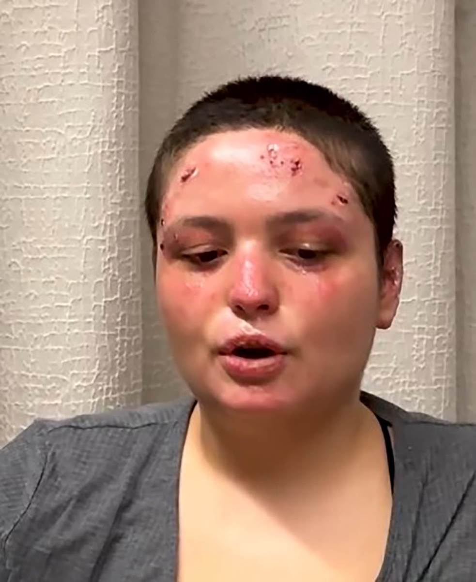 Preživela žrtva požara u Švajcarskoj (5).jpg