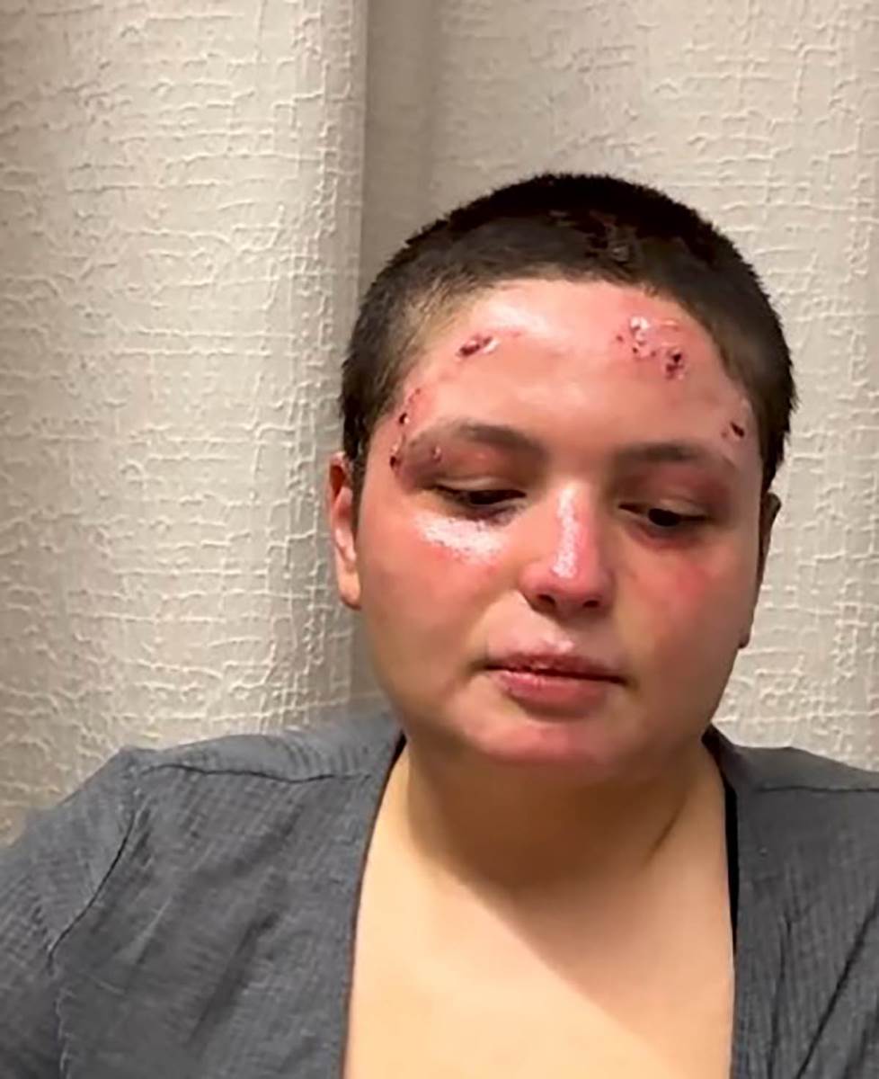 Preživela žrtva požara u Švajcarskoj (1).jpg