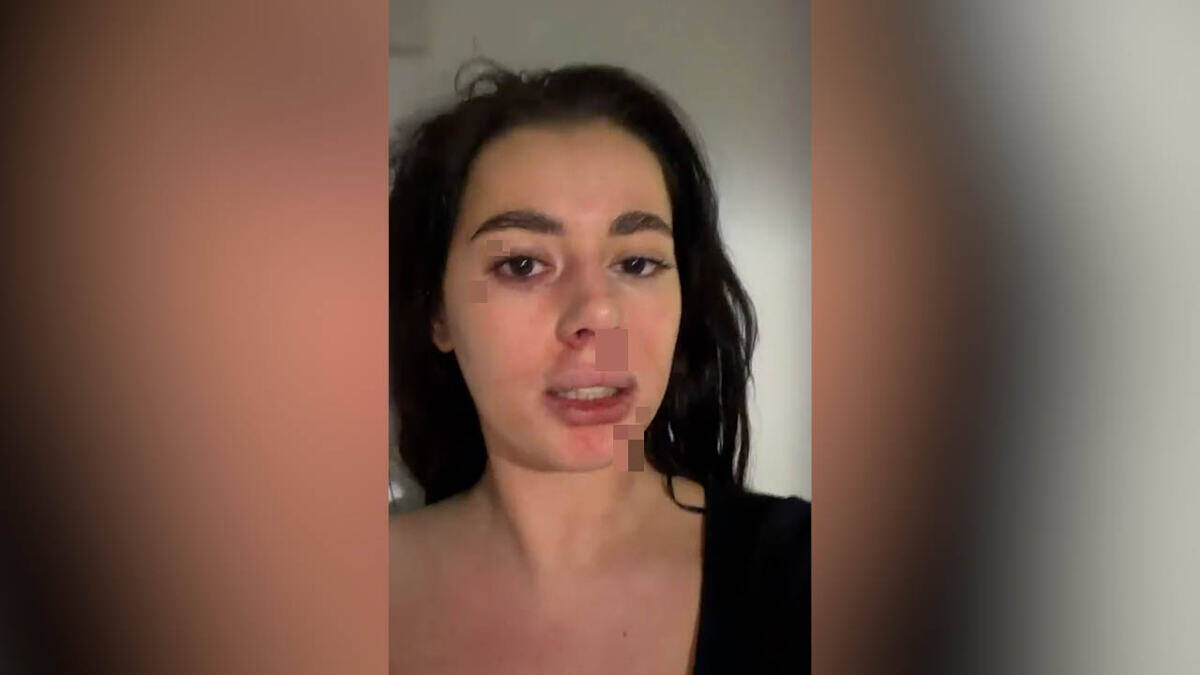 Pretučena bivša rijaliti učesnica: Pronašla poruke u partnerovom telefonu, pa doživela pakao (Foto)