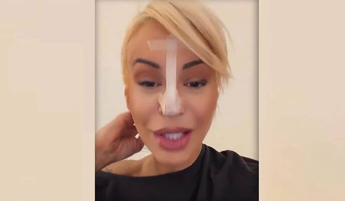 "Pao mi je vrh nosa": Dušica Jakovljević šokirala prizorom, celo lice oblepila flasterima