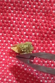 kamen u bubregu 6.png