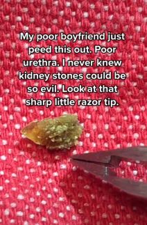 kamen u bubregu 5.png