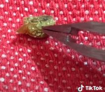 kamen u bubregu 4.png