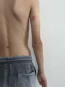 Ujedi stenica (4).jpg