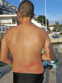 Dečak u Herceg Novom dobio opekotine od meduze