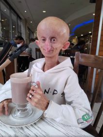 Preminula tiktokerka koja je bolovala od retkog genetskog poremećaja