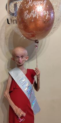 Preminula tiktokerka koja je bolovala od retkog genetskog poremećaja