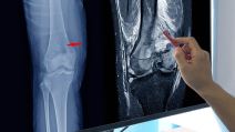 tumor u nozi