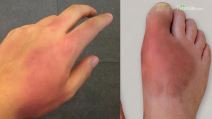 Simptomi lepre na šaci i stopalu
