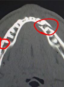 Slomljena vilica Džejk Pola