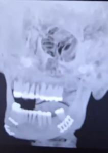 Polomljena vilica i zubi Džejk Pola